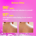 Innovist Acne Control Body Wash